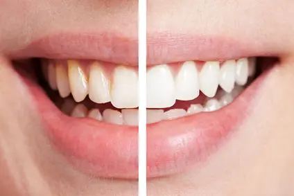 Professionelles Bleaching für weisse Zähne